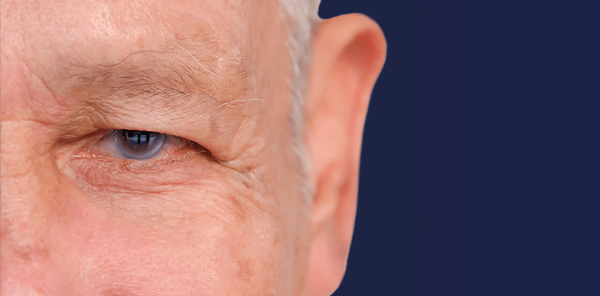 Glaucoma Treatment