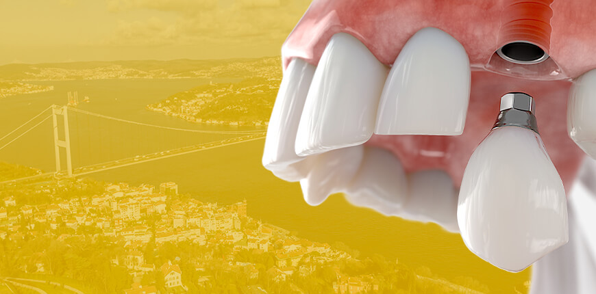 How Long Do Dental Implants Last?