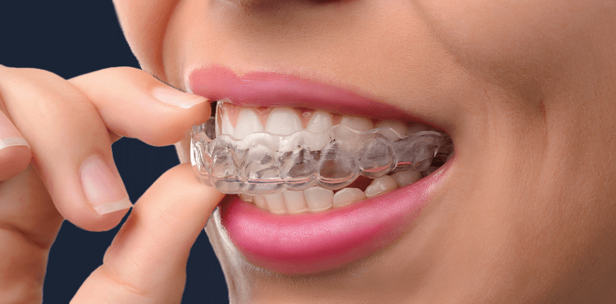 Invisalign