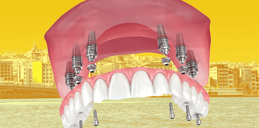 Maintaining Oral Dental Health After All-on-6 Dental Implant Surgery