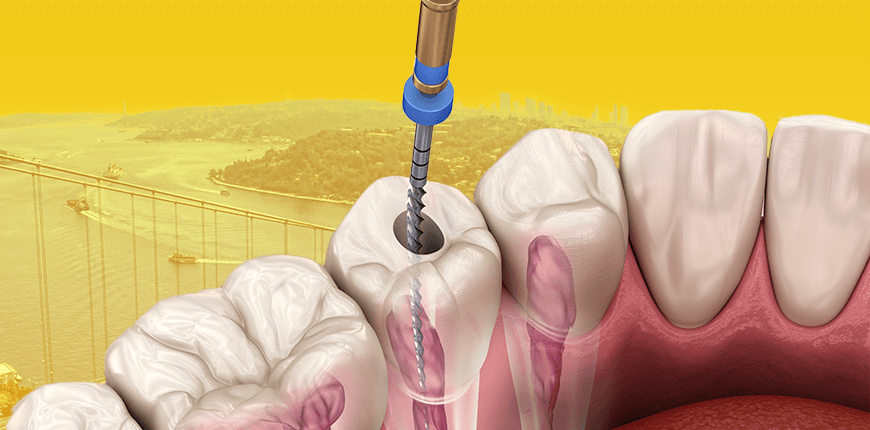How Long Should You Expect a Root Canal to Take?