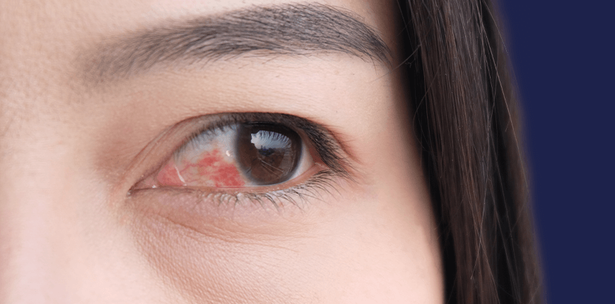 Retinal Detachment Treatment