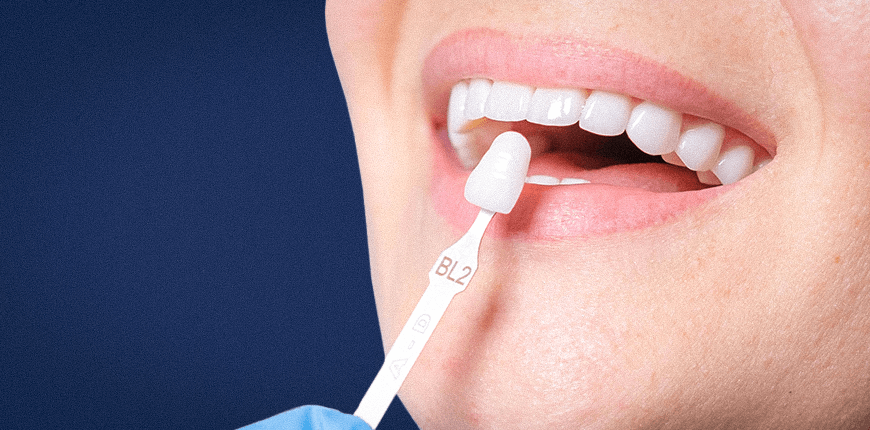 Dental Veneers